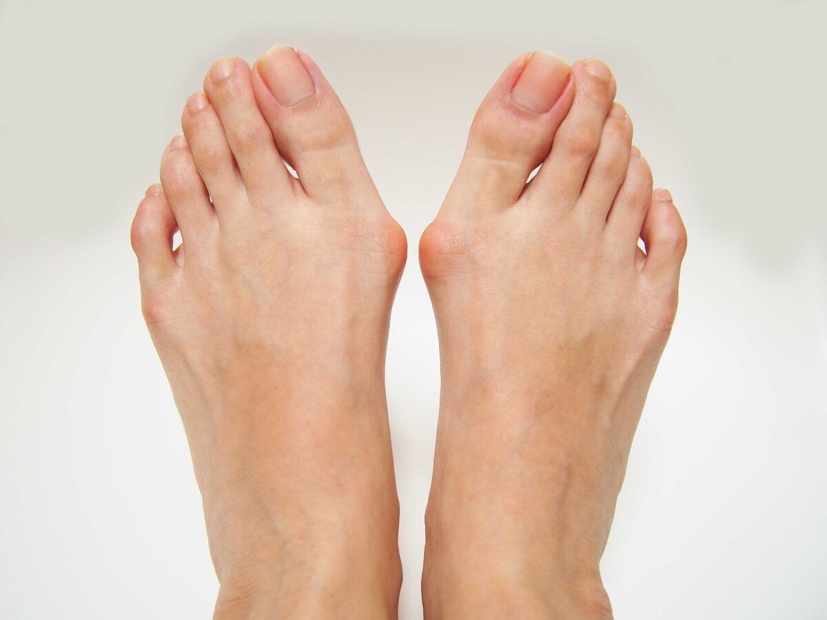 Косточка на ноге