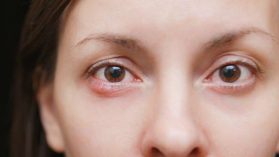 Причины возникновения 
Как быстрее вылечить

Глаза — зеркало души. Они отражают внешний мир, душа воспринимает его, и ее реакция так или иначе сказывается на здоровье глаз . Ячмень — одно из заболеваний, которое может возникнуть от душевных проблем.

Ячмень — это воспаление слизистой глаза. Оно может возникнуть возле ресничного контура, на веке и даже под веком. Считается, что его главный возбудитель — бактерия стафилококка. Она попадает из окружающей среды в организм человека, но может вызвать заболевание не сразу, а когда иммунитет ослаблен. Но знаешь ли ты, что иммунитет ослабляют твои негативные эмоции? Именно они вызывают ячмень на глазу. Психосоматика болезни включает несколько причин, и от них зависит, как ее лечить.

Как правило, ячмень проходит довольно быстро, но, если ты заметила, что он возникает подозрительно часто, либо если он долго не проходит и уже доставляет немало дискомфорта, скорее всего, его причина, прежде всего, психологическая.

Ячмень на глазу: причины по психосоматике