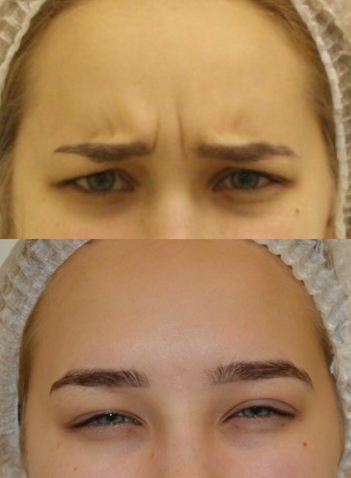 Коррекция мимических морщин. Ксеомин 50 ед. все лицо