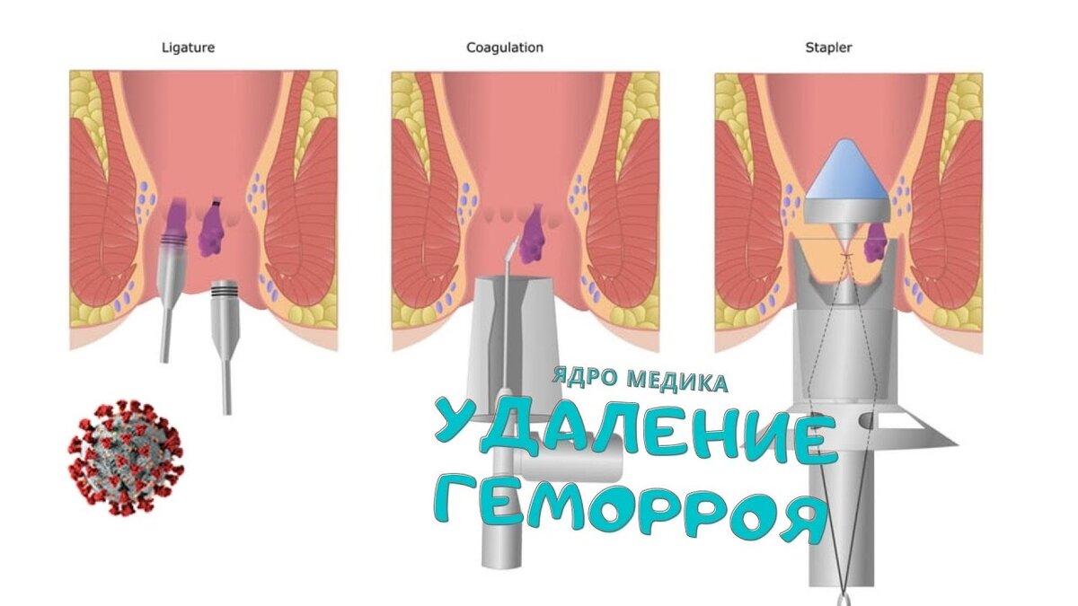 После удаления геморроя как сходить в туалет. Геморроидэктомия Лонго. Инфракрасная фотокоагуляция геморроидальных узлов. Тромбэктомия геморроидального узла операция.