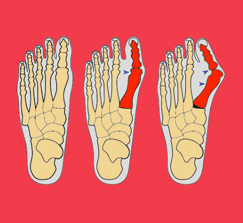 Вальгусная косточка на ноге. Вальгусная деформация большого пальца стопы. Вальгусная деформация стопы косточка. Вальгусная деформация стопы и подагра. Вальгусная деформация косточки.