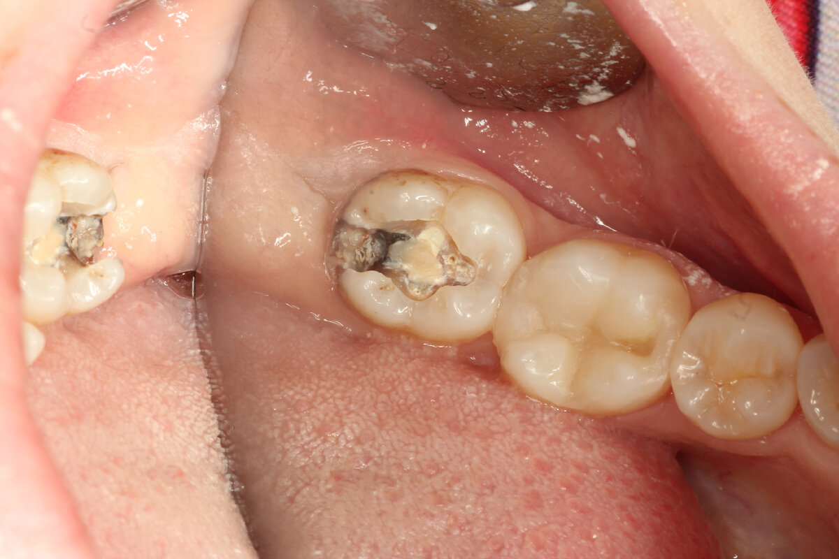 Промежуточный этап, вся задняя часть зуба в кариесе