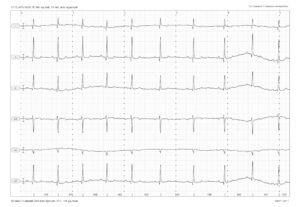 Электрокардиограмма (ЭКГ)