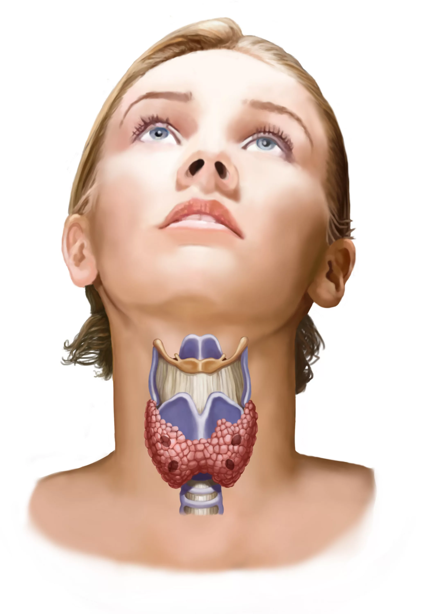 Как выглядит щитовидка. Зоб щитовидной железы у женщин. Струма щитовидной железы.