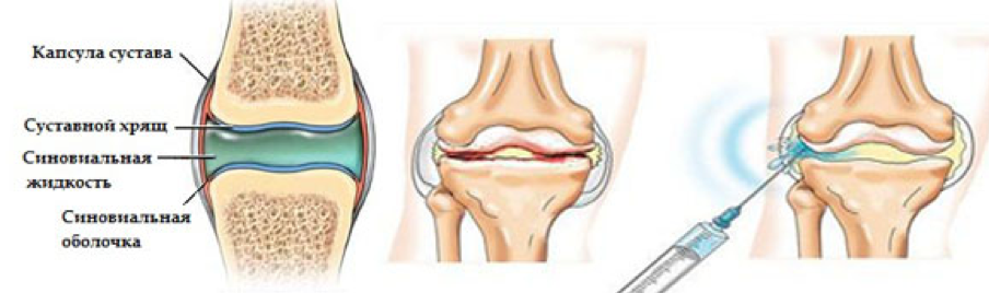 Укол в колено синовиальная жидкость синовиальная. Техника введения гиалуроновой кислоты в коленный сустав. Синовиальная жидкость в коленном суставе гиалуроновая кислота.