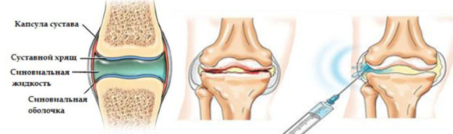 Укол в колено при артрозе как называется. Синовиальная жидкость коленного сустава гиалуроновая кислота. Артроз синовиального жидкости в суставах. Блокада Дипроспан коленный сустав.