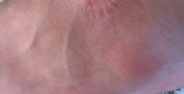 Бугорки, шишки и уплотнения на внутренней стороне бедра