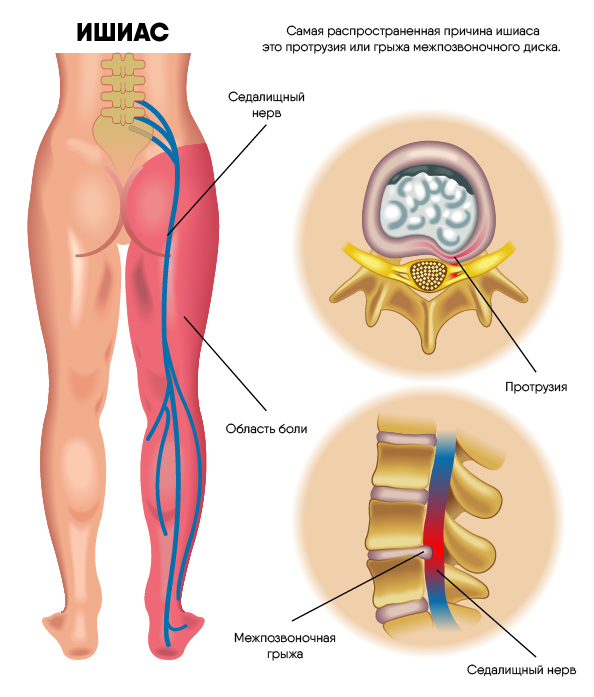 Болит ягодица от укола очень сильно про ходьбе,напряжении ее!