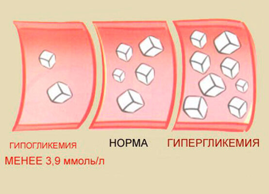 Гипогликемия картинки для презентации