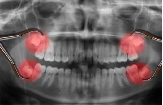 расположение зубов мудрости