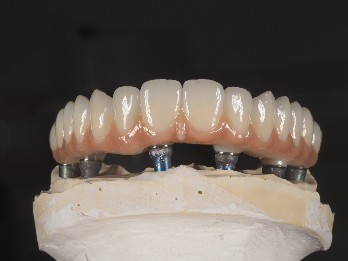 Что было сделано: удалены все зубы на верхней челюсти, с одномоментной установкой 8 имплантатов, через 1 день фиксация временного протеза (чтобы пациент мог нормально жевать. На нижней челюсти была проведена имплантация в боковых отделах. Также мы провели тенс-терапию (для расслабления мышц, чтобы вернуть их в исходное положение). После приживления имплантатов было сделано постоянное протезирование; на верхней челюсти установлен несъёмный протез. На нижней челюсти установлены коронки на имплантатах в боковых отделах, и коронки на фронтальных зубах. 