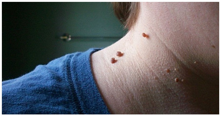 Это лучший способ удалить бородавки самостоятельно! У многих людей есть такие маленькие кожные бородавки, а иногда и большие. Кожные бородавки на самом деле не имеют ничего общего с бородавками, а просто вызваны наростами определенных клеток соединительной ткани. Тем не менее, они могут раздражать. И вот как вы легко удаляете их самостоятельно!