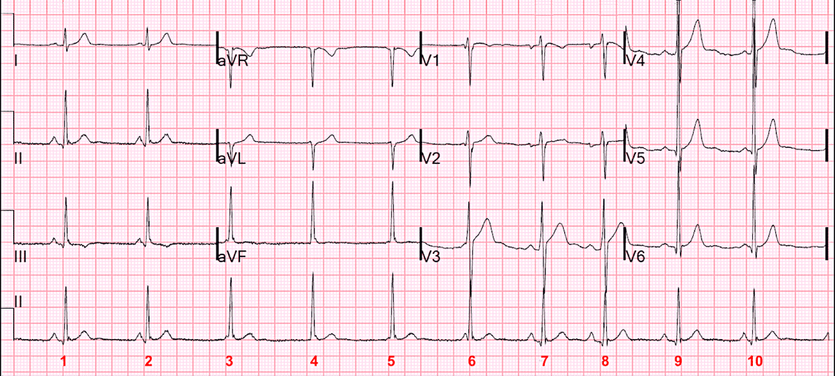 На полосе ритма во II отведении я пронумеровал комплексы