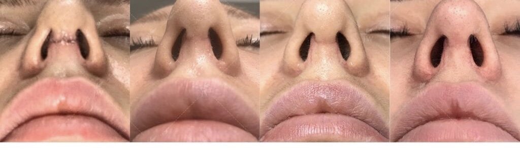 Рубец после ринопластики