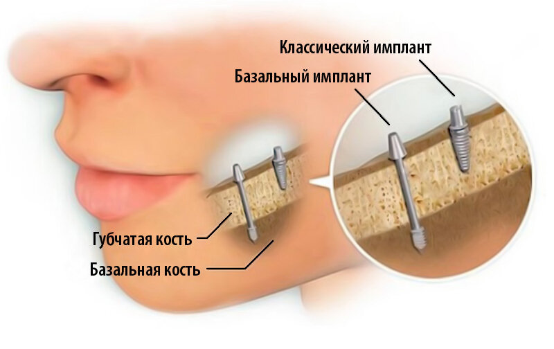 Сравнение базальной и классической имплантации