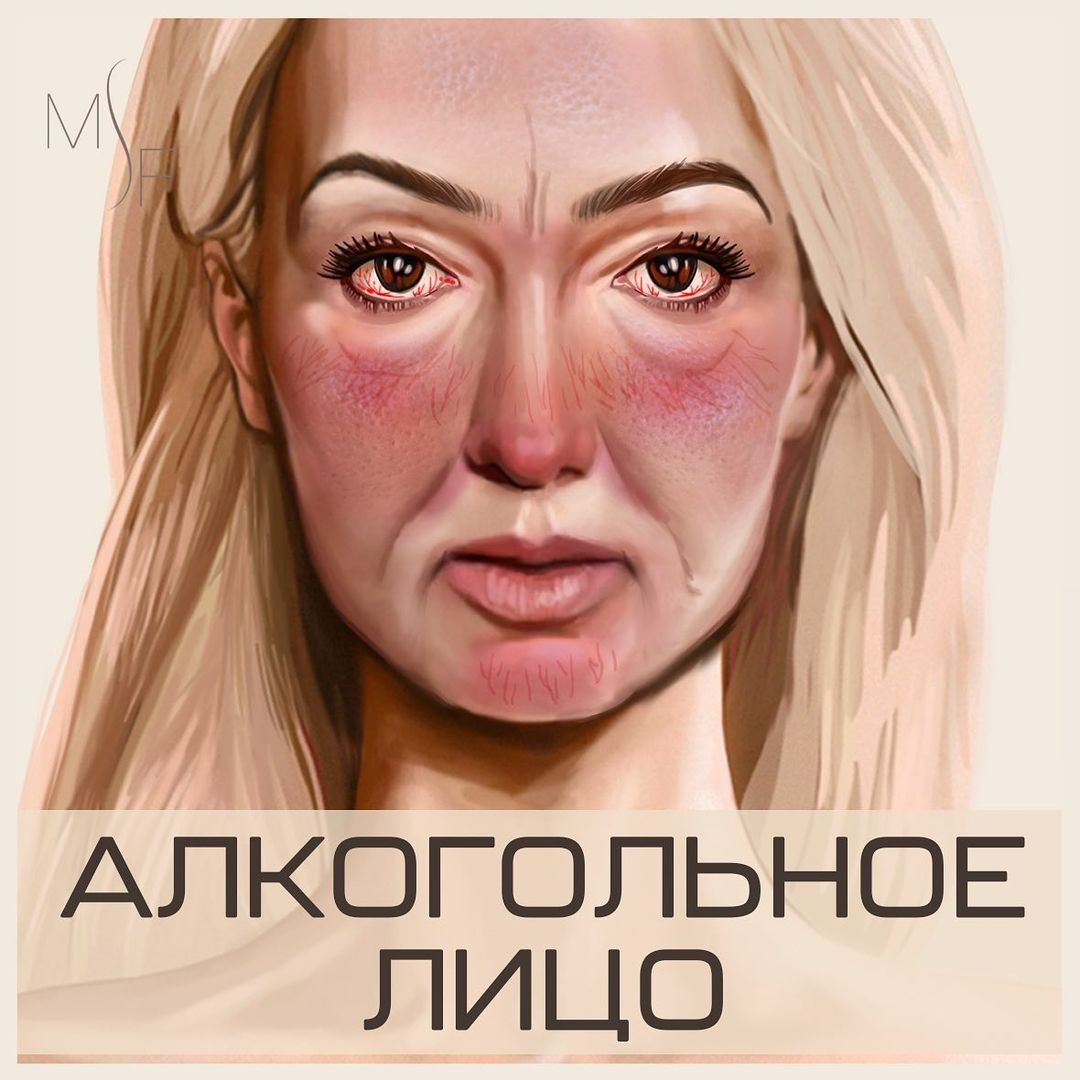 Выпил лицо. Алкогольное лицо женщины. Лица женщин которые выпивают. Алкоголическое лицо у женщин