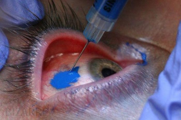 Врачи предупреждают, что татуировка глазного яблока может привести к слепоте