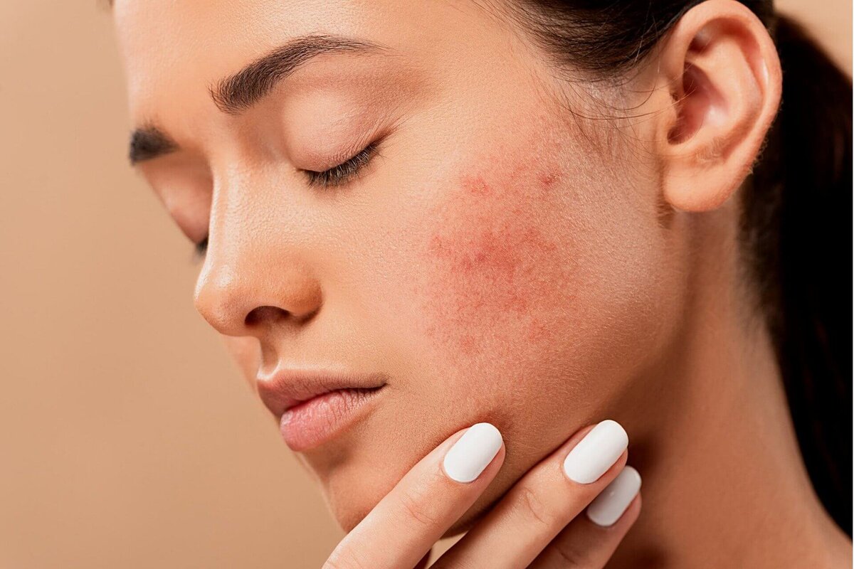 Treatment of acne concomitant with seborrheic dermatitis