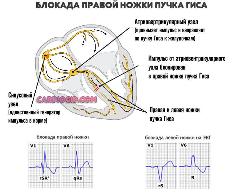 Что такое полная или неполная блокада ножки пучка Гиса на ЭКГ у ребенка