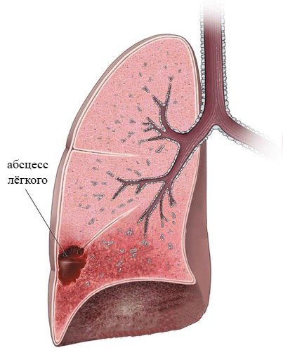 Абсцесс легкого рисунок