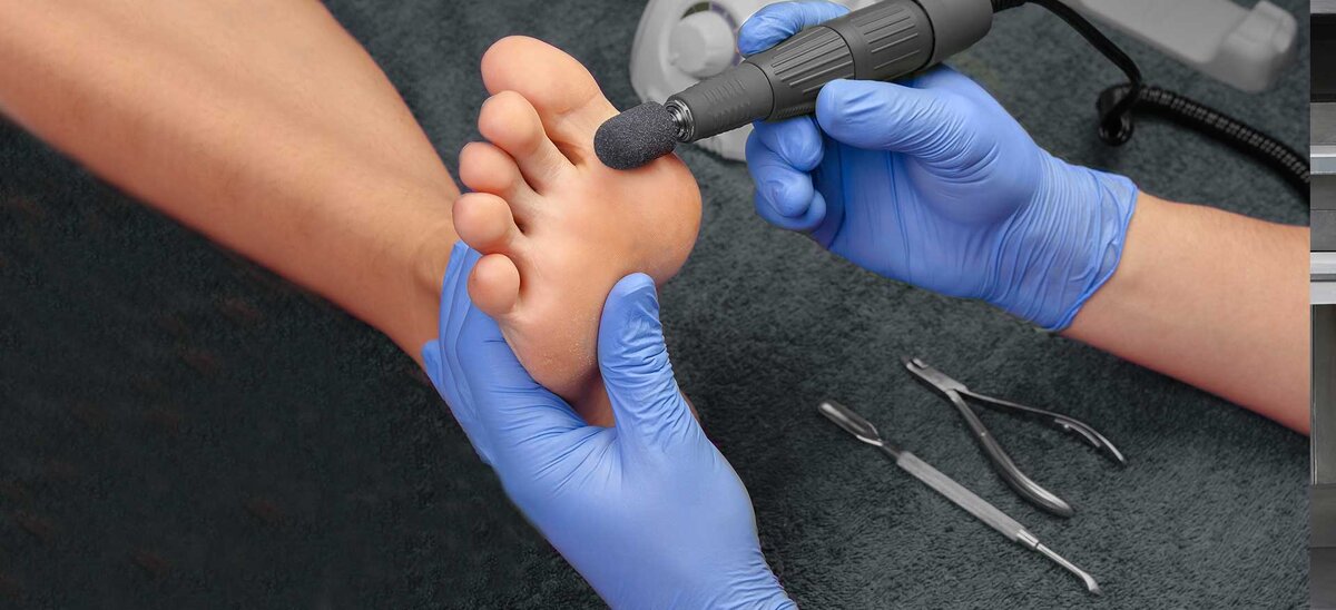 удаление мозоли