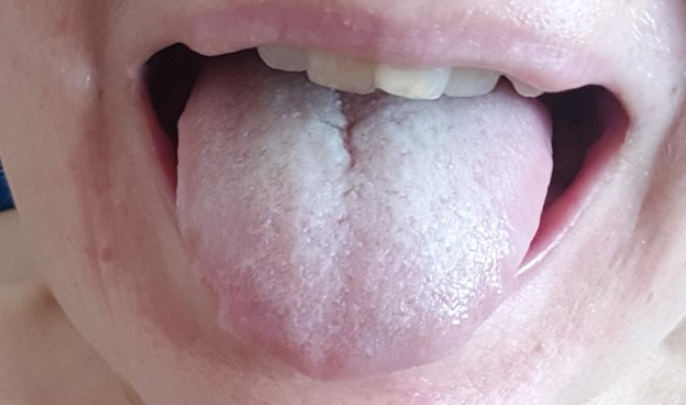 Налет на языке – рассадник бактерий . Фото: Яндекс.Картинки