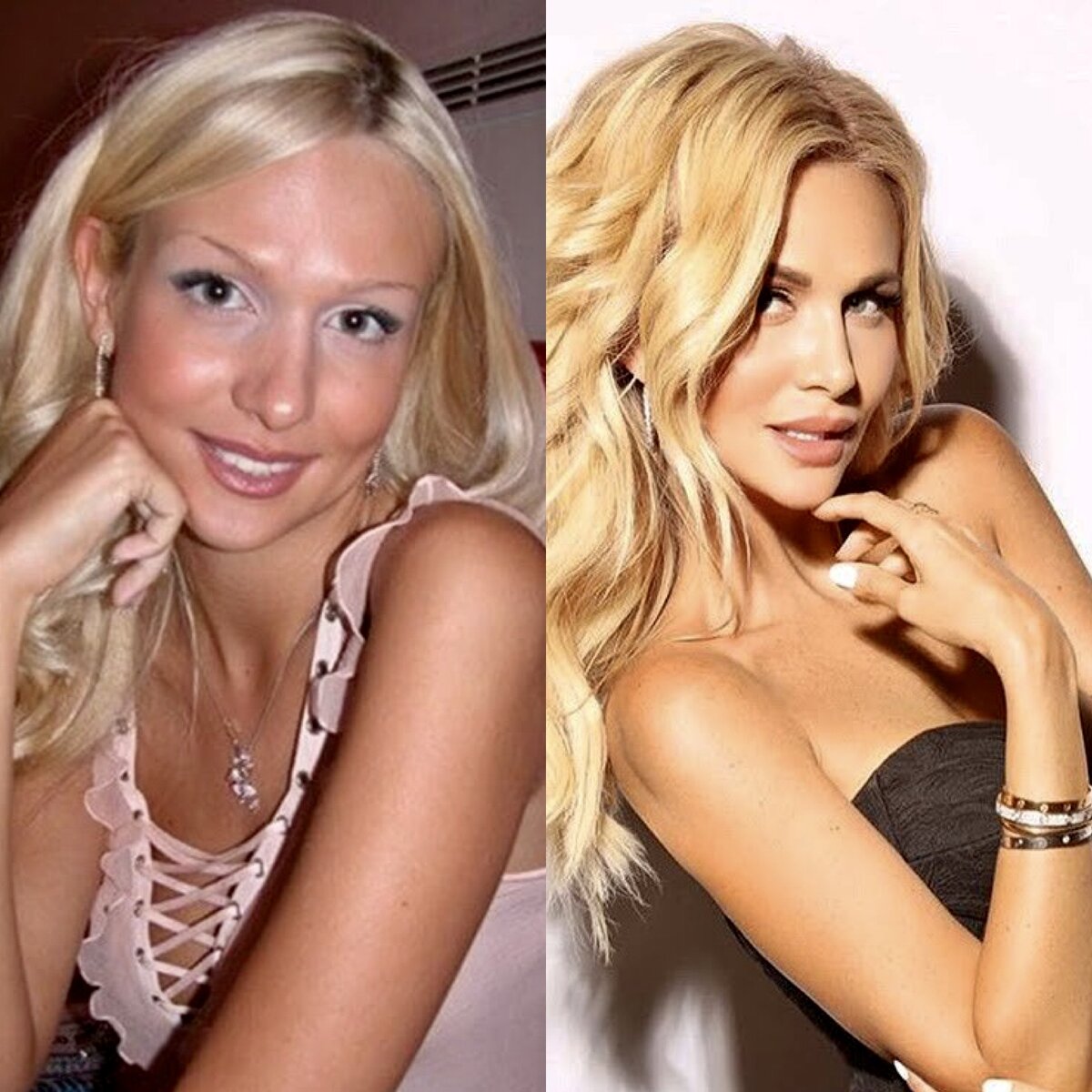 Виктория Лопырева «До» и «После» пластики