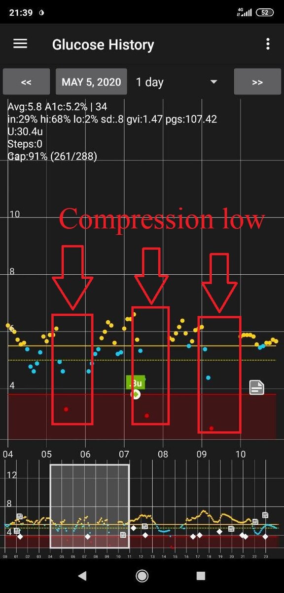 Иллюстрация резкого падения показаний сахара "compression low" для Dexcom G6 из-за прижатого сенсора