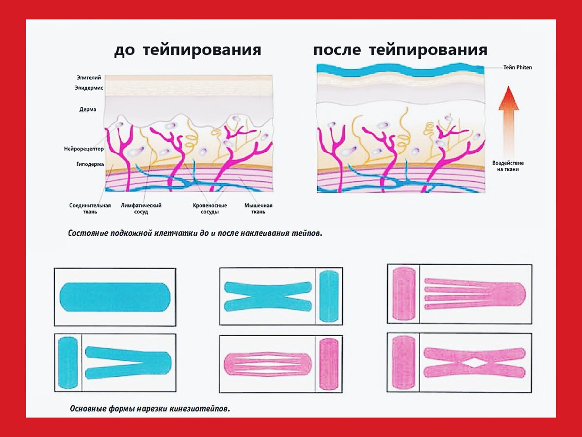 Тейпирование для похудения и подтяжки схема. Термаж схема воздействия. Подкожный слой. Схема влияния истинного течения.