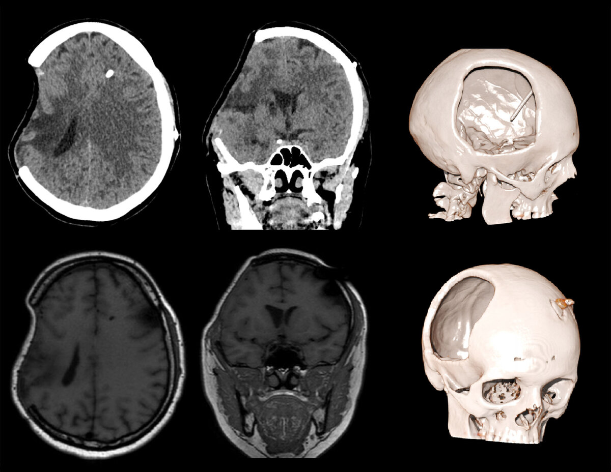 Травмы черепа и головного мозга. Проникающая ЧМТ рентген. Открытая проникающая ЧМТ. Перелом затылочной кости кт.