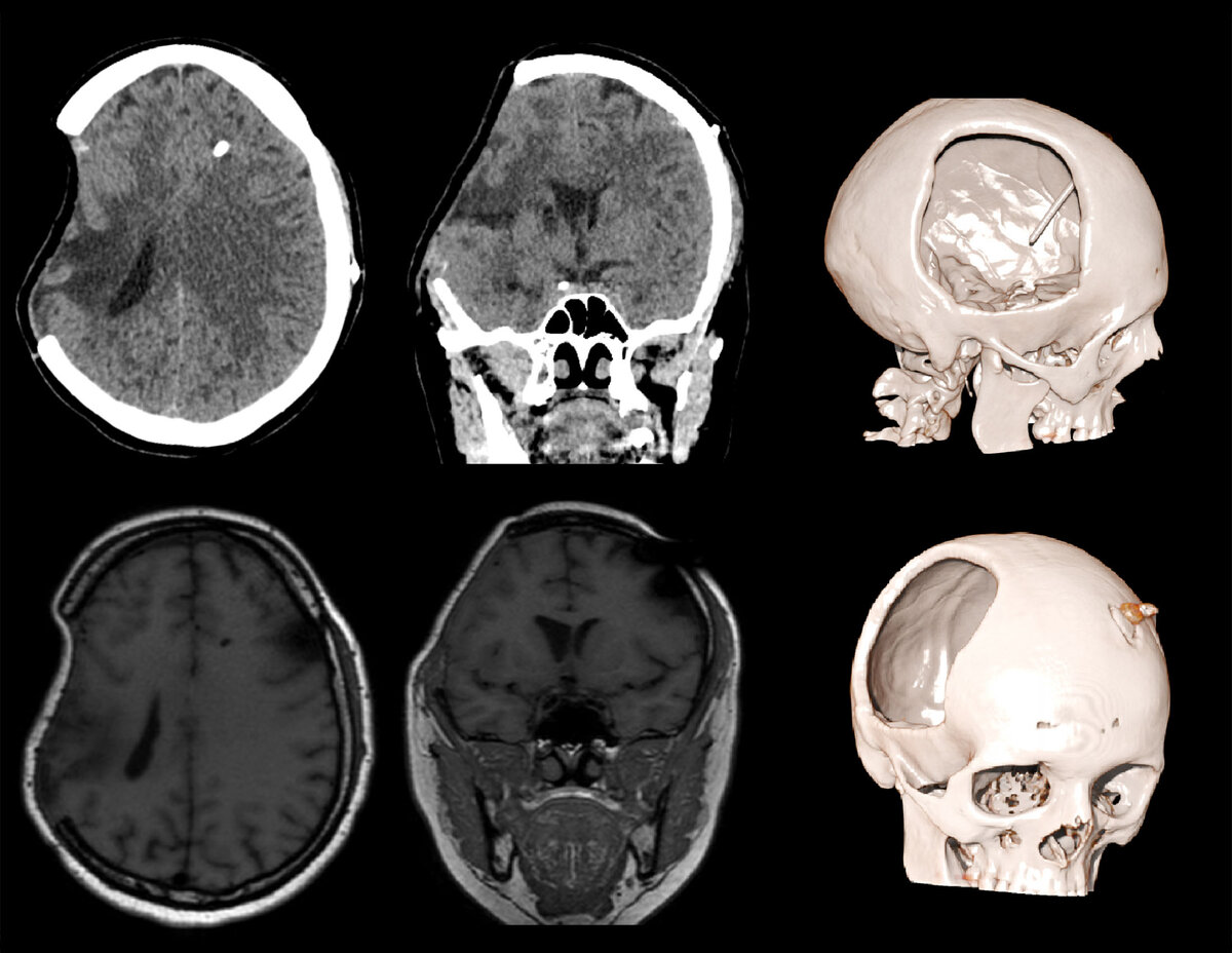 Проникающая ЧМТ рентген. Открытая проникающая ЧМТ. Перелом затылочной кости кт. Травмы черепа и головного мозга