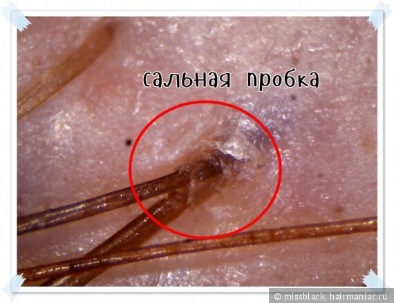 Сальная пробка причина плохого роста волос