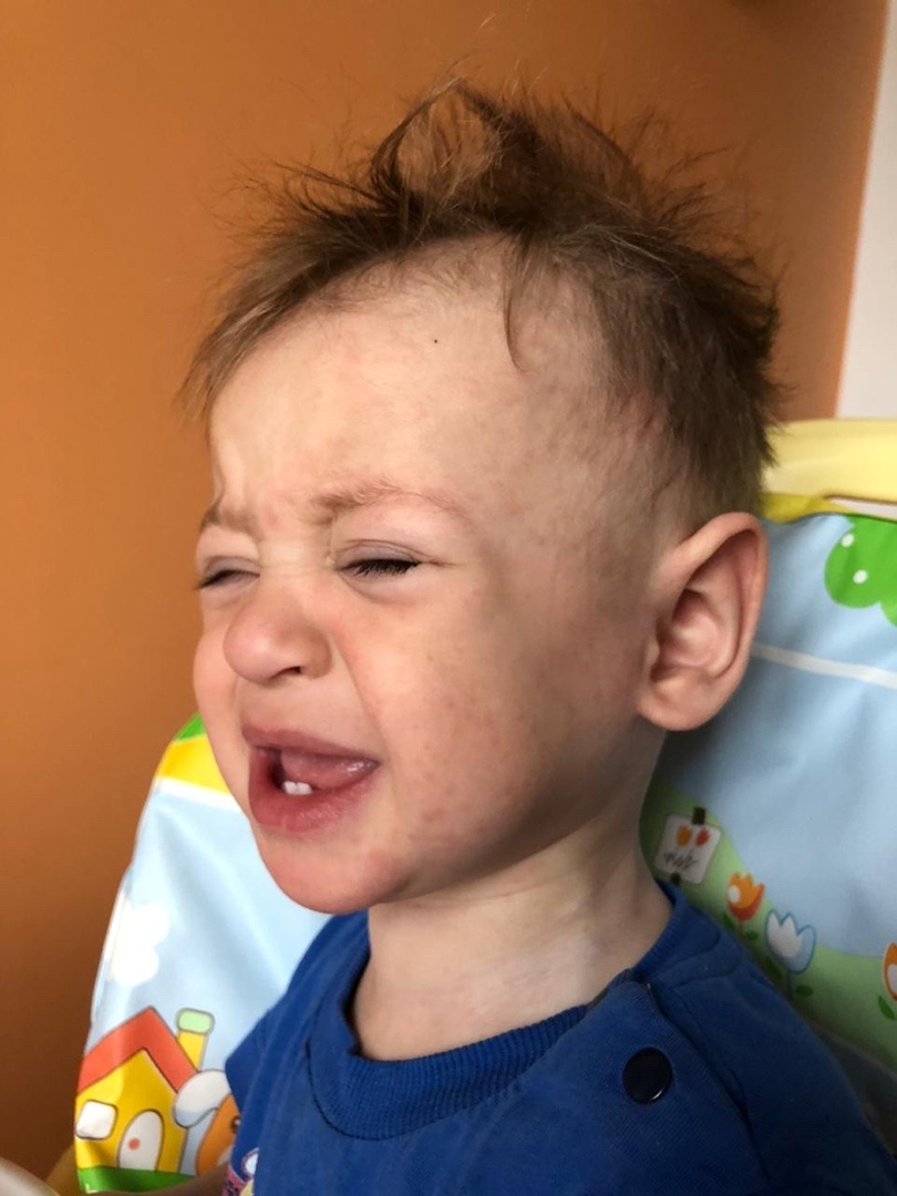 Вот такая сыпь, на следующий день еще ярче была.