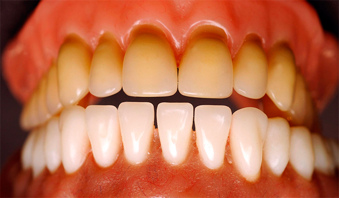 Описание тетрациклиновых зубов