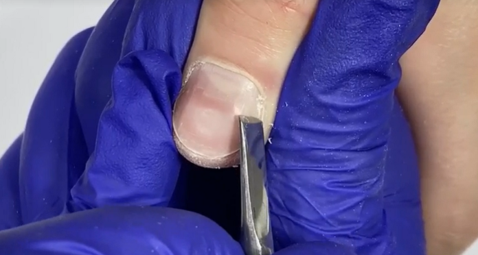 На данном изображении выполняется правильное удаление птеригия. 