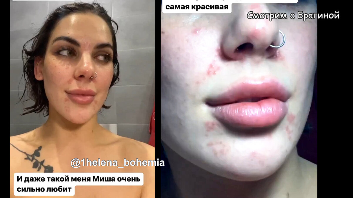 Алёна Опенченко показала сыпь, инстаграм