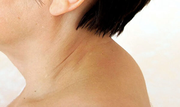 Холка человека (вдовий горбик) чаще наблюдается у женщин