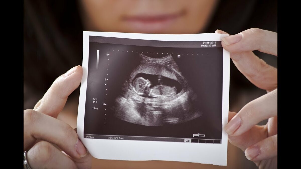 Примерно так выглядит ребенок на 11-13 неделе беременности