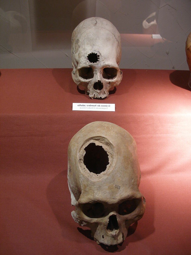 Чаще "дыры" можно обнаружить в теменной доле, но встречаются и такие, как здесь — в лобной