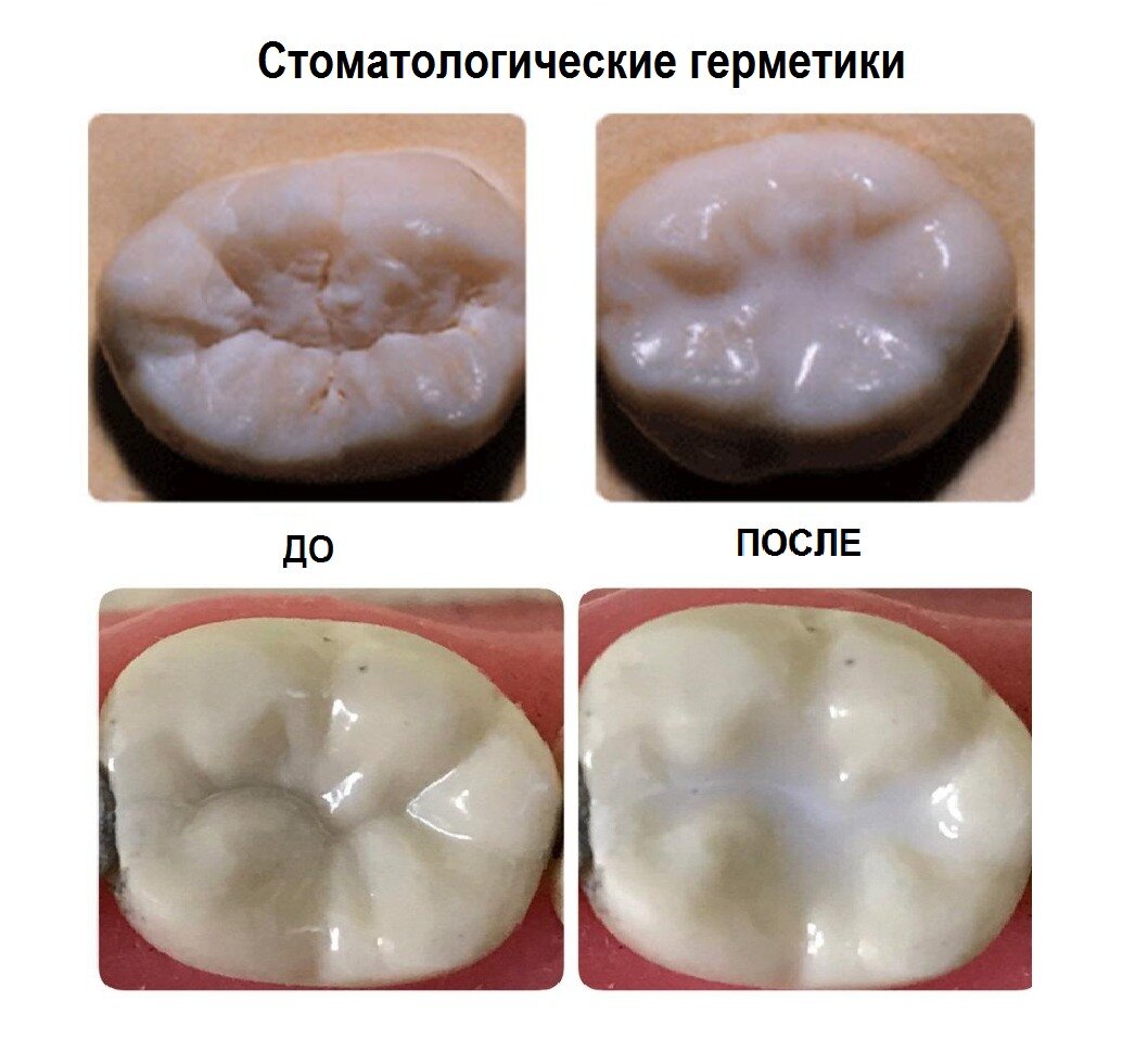 Как выглядит жевательный зуб