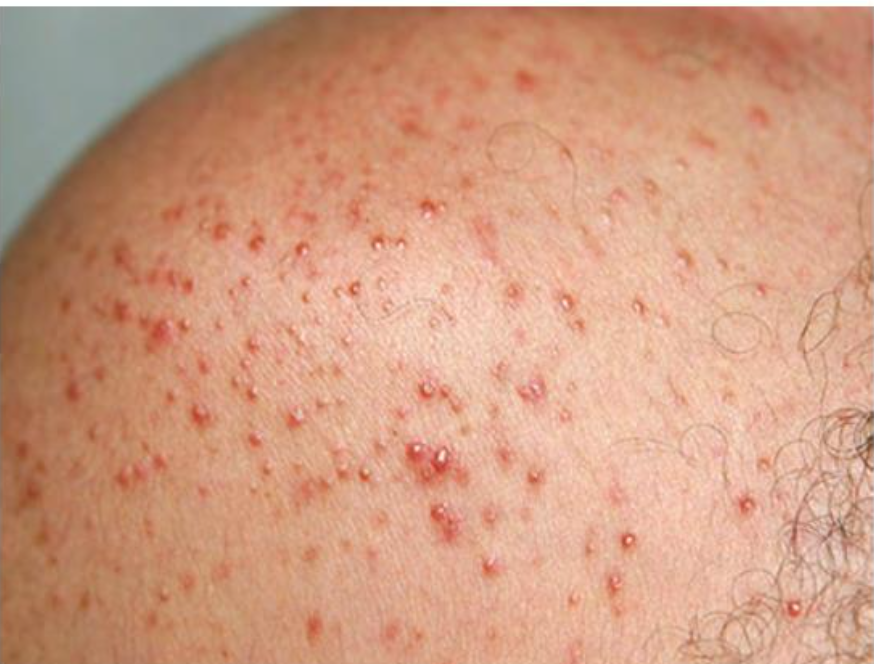 Папуло-пустулезная сыпь при малассезия-фолликулите.