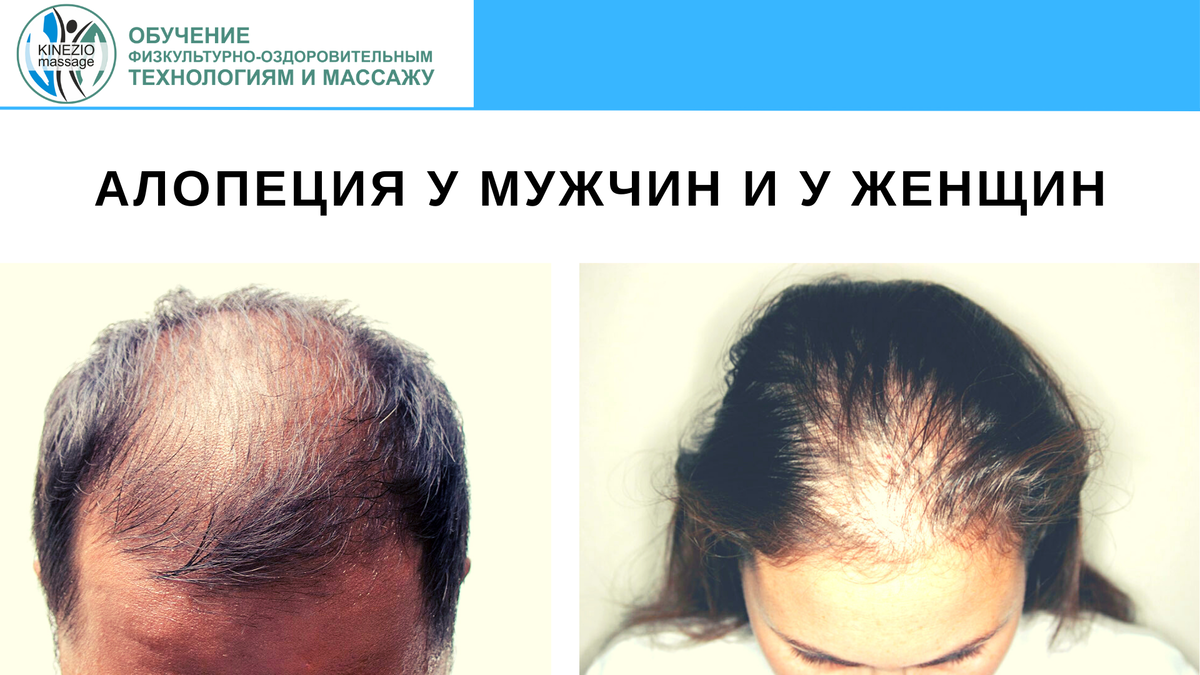 Personas que se han curado de alopecia areata