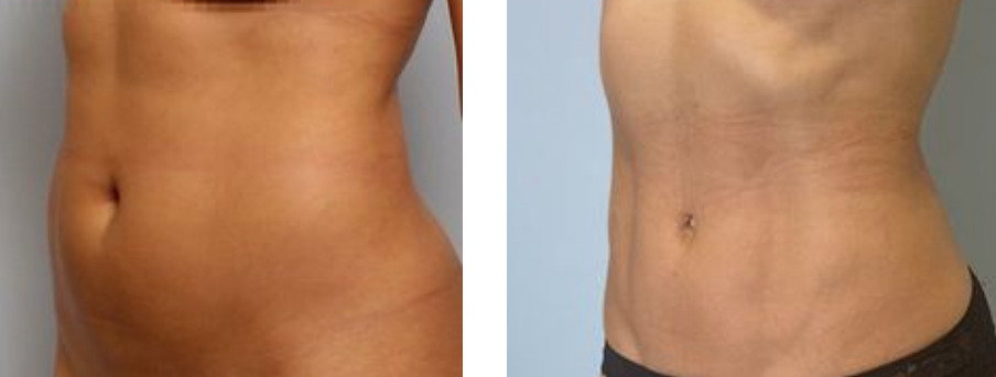 Результаты до и после бодибилдинг липосакции 