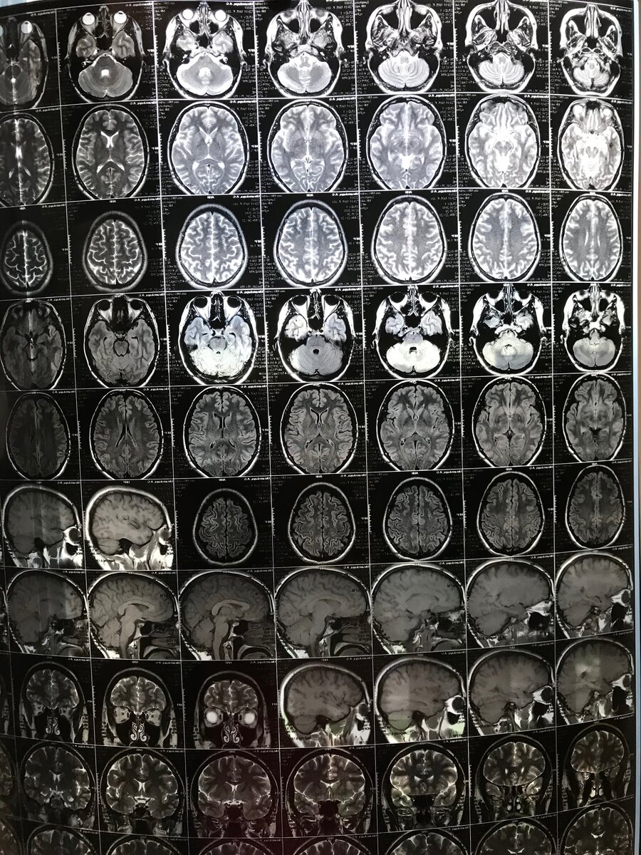 МРТ головного мозга напомнило мне игру на там-таме и погружение в пещеру |  Медицинский парадокс | Дзен