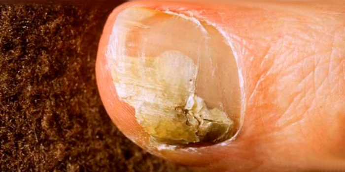 Как выглядит онихолизис? Идентификация врага
Кто информирован — вооружен. Онихолизис имеет вид воздушной прослойки, ноготь и его свободный край обретают неестественную форму с нечеткими очертаниями полумесяца.Также следует обратить внимание на цвет воздушной «подушечки» — синевато-белесый, желтоватый и коричневый — это не является нормой и врачи подологи настоятельно рекомендуют обращаться к специалисту при появлении симптомов. Раньше начать лечиться, означает быстро побороть проблему.