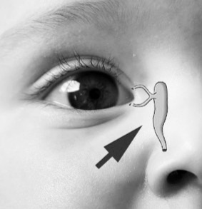 Вот этот нослслезный канал забит ,поэтому глаза гноятся и слеза не проходит. 