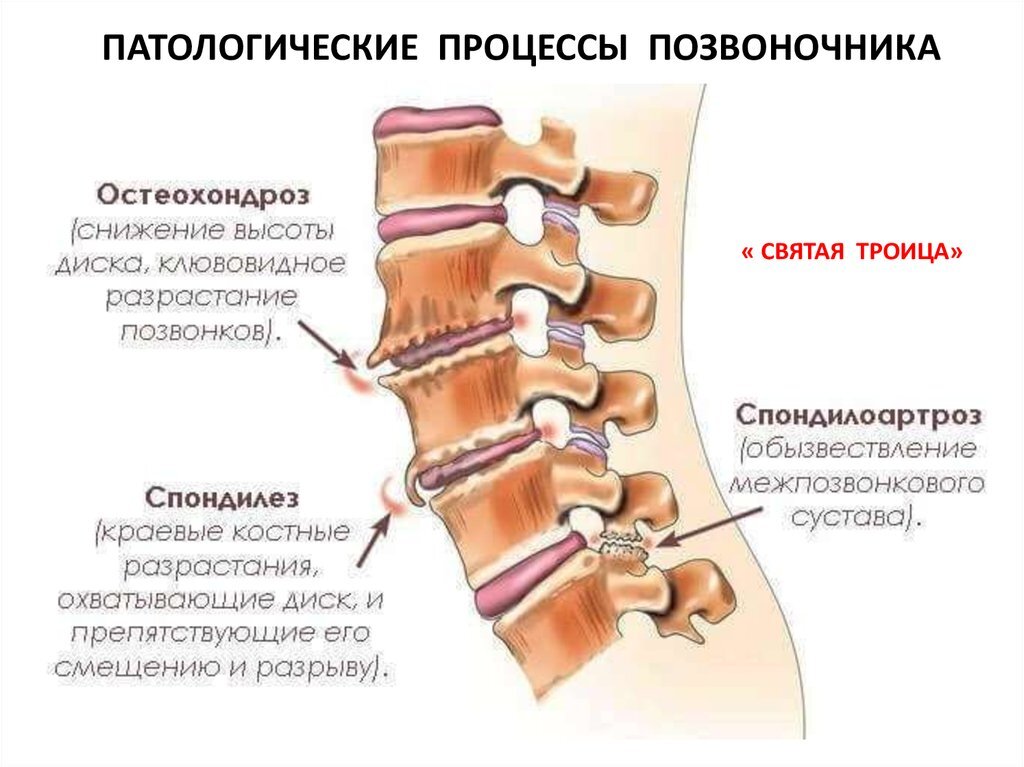 Мр картина дегенеративно дистрофических изменений пояснично крестцового отдела