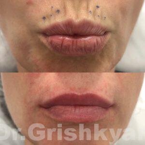Коррекция губ инъекциями ботокса. Фотография с сайта Д.Р. Гришкяна. Имеются противопоказания, требуется консультация специалиста.