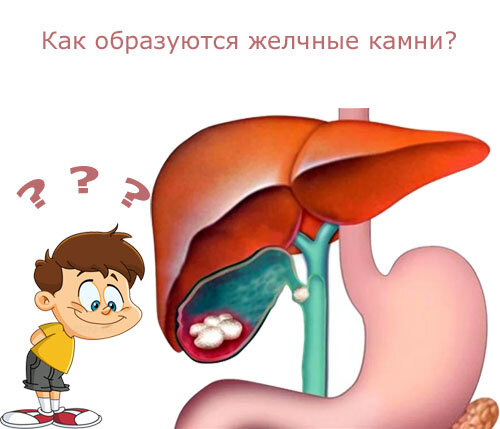 Теории образования желчных камней. От чего образуется желчный камень. Механизм образования желчных камней. Жкб камни желчного пузыря. Желчнокаменная болезнь холестериновые камни.
