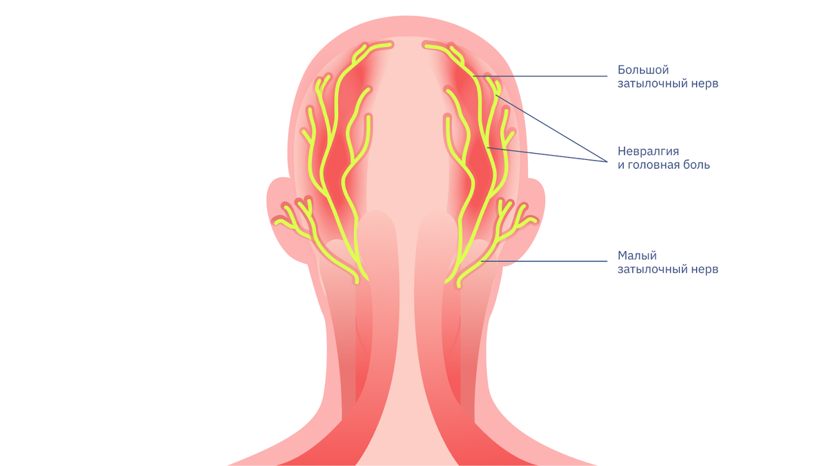 Большой затылочный нерв и ременная мышца головы